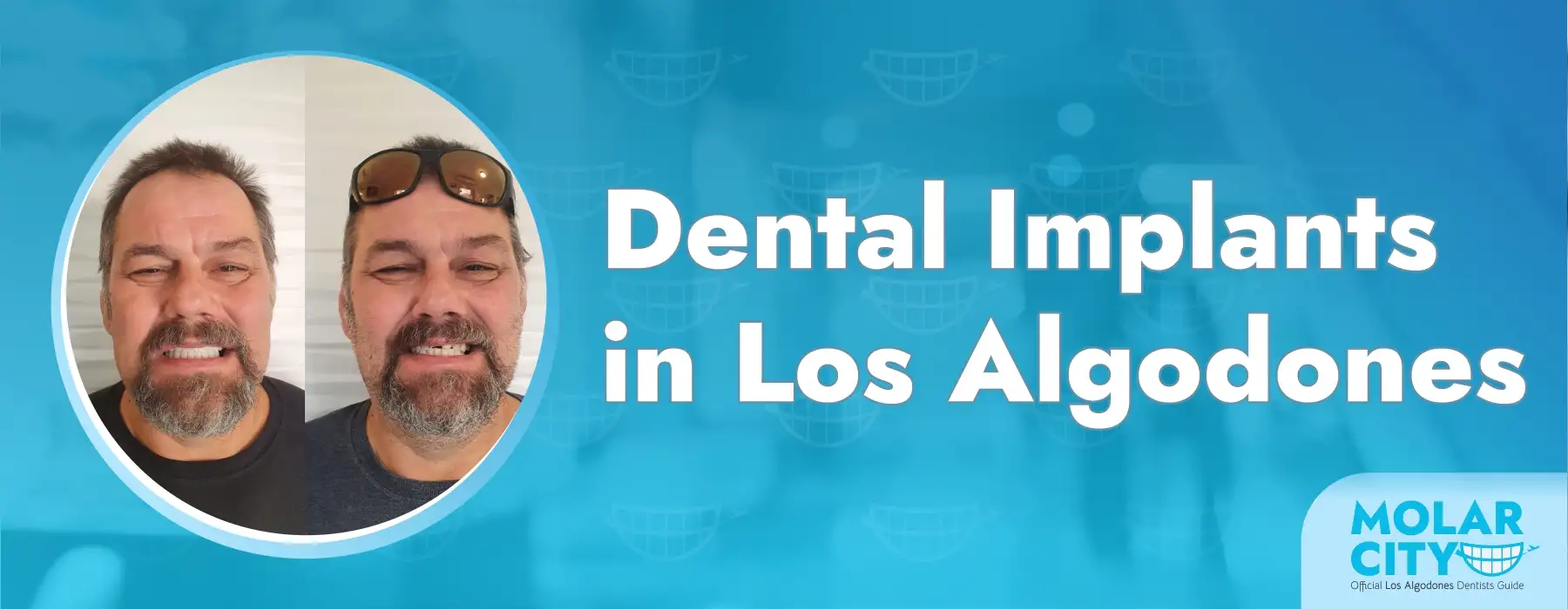 Dental Implants in Los Algodones